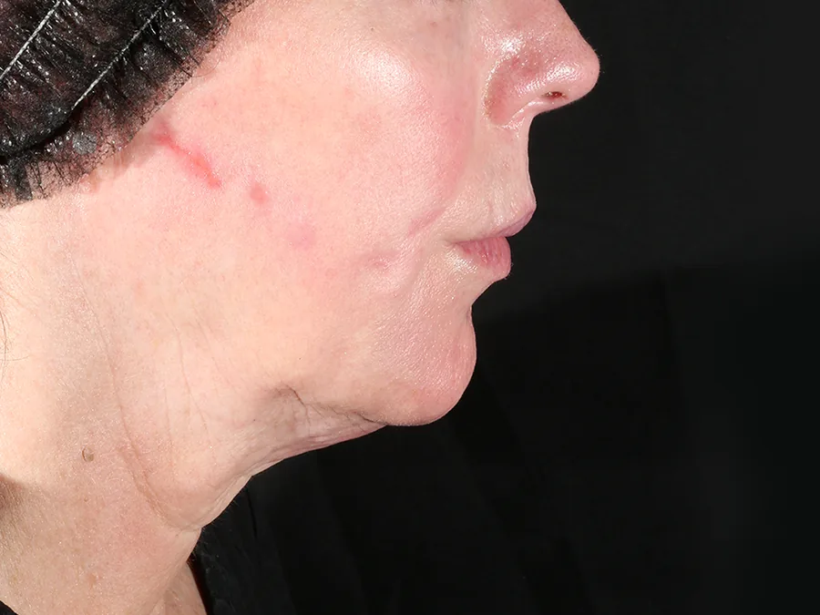 Perfil do rosto e pescoço antes do tratamento.