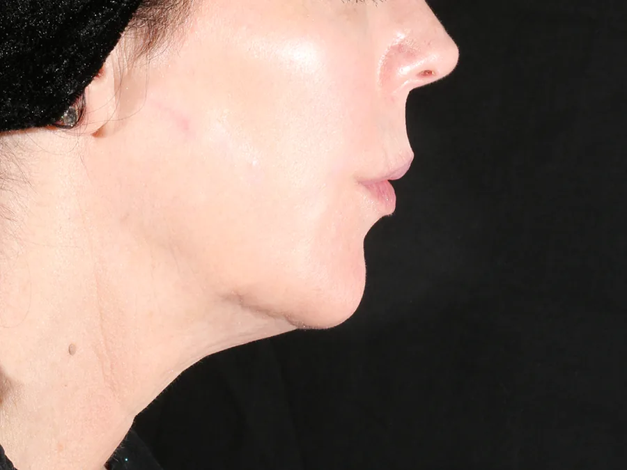Perfil do rosto e pescoço após o tratamento.